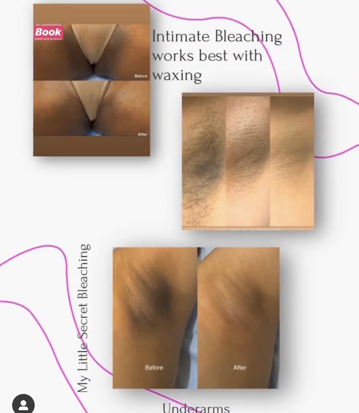 Intim bleaching before after